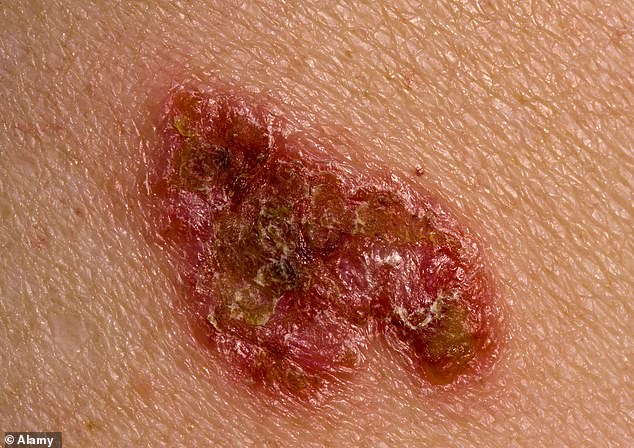 The most common types of skin cancer are basal cell carcinoma (pictured, which develop from cells in the deepest part of the outer layer of the skin) and squamous cell (generally faster growing and beginning in the epidermis, the most ­superficial skin layer)