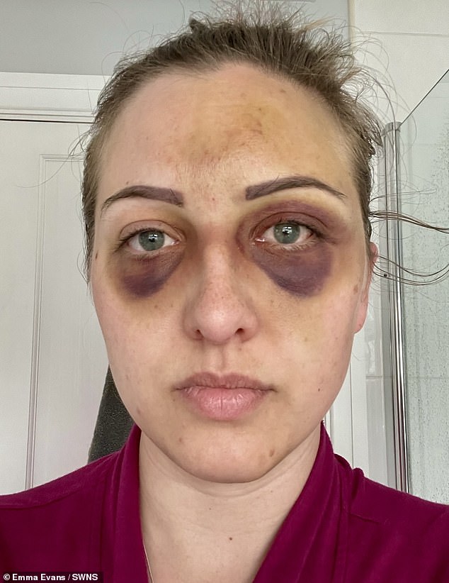 Bilder, die nach Emmas Anfall aufgenommen wurden, zeigen sie mit violetten Blutergüssen unter den Augen, nachdem in ihrem Gesicht Blutgefäße geplatzt waren