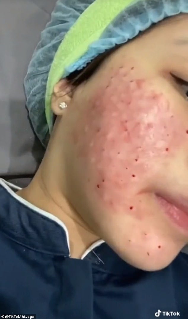 Ein weiteres TikTok-Video von @hi.vega, die mehr als 4.800 Follower hat, zeigt, wie sie in einer Klinik die Injektionen bekommt.  Nach der Behandlung ist ihr Gesicht klumpig und voller Blut