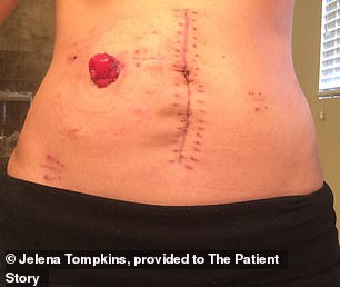 Frau Tompkins wurden 12 Zoll ihres Dickdarms und Rektums sowie 17 Lymphknoten entfernt und ihr wurde ein Ileostomiebeutel angelegt