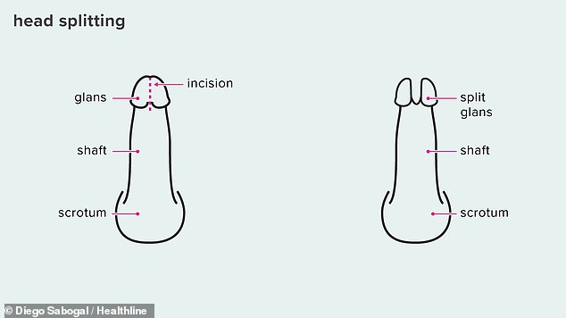 Ein weniger verbreiteter Eingriff im Genitalbereich, auf den Dr. Crane nicht näher eingegangen ist, ist das sogenannte Penissplitting, eine Art Körpermodifikation, bei der der Penis an verschiedenen Stellen in zwei separate Abschnitte geteilt wird.  Es ist nicht bekannt, ob die Klinik dies durchführt