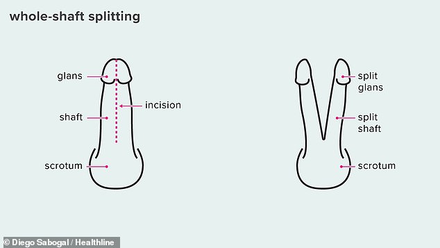 Eine Illustration von Healthline zeigt die Spaltung des gesamten Penis, bei der der gesamte Penis in zwei separate Teile geschnitten wird.  Es ist nicht bekannt, ob die Klinik dies durchführt
