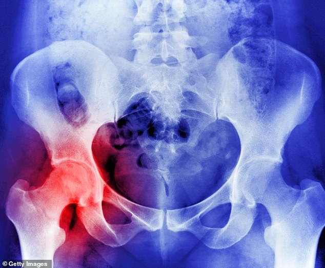 Ein Röntgenbild zeigt Osteoporose, die zu einem Hüftgelenkersatz führte
