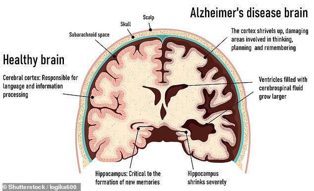 Die Alzheimer-Krankheit ist die sechsthäufigste Todesursache in den USA. 6,9 Millionen Menschen leben mit dieser Krankheit, und bis 2050 wird sich diese Zahl voraussichtlich verdoppeln