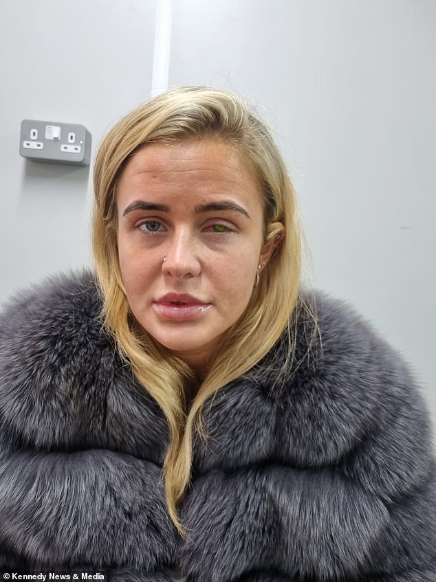 Lillie Barrett, 22, aus Welling im Südosten Londons, begnügte sich mit einem teuren Paar russischer Wimpernverlängerungen, bekam jedoch kurz darauf ein juckendes linkes Auge und war sogar vorübergehend blind