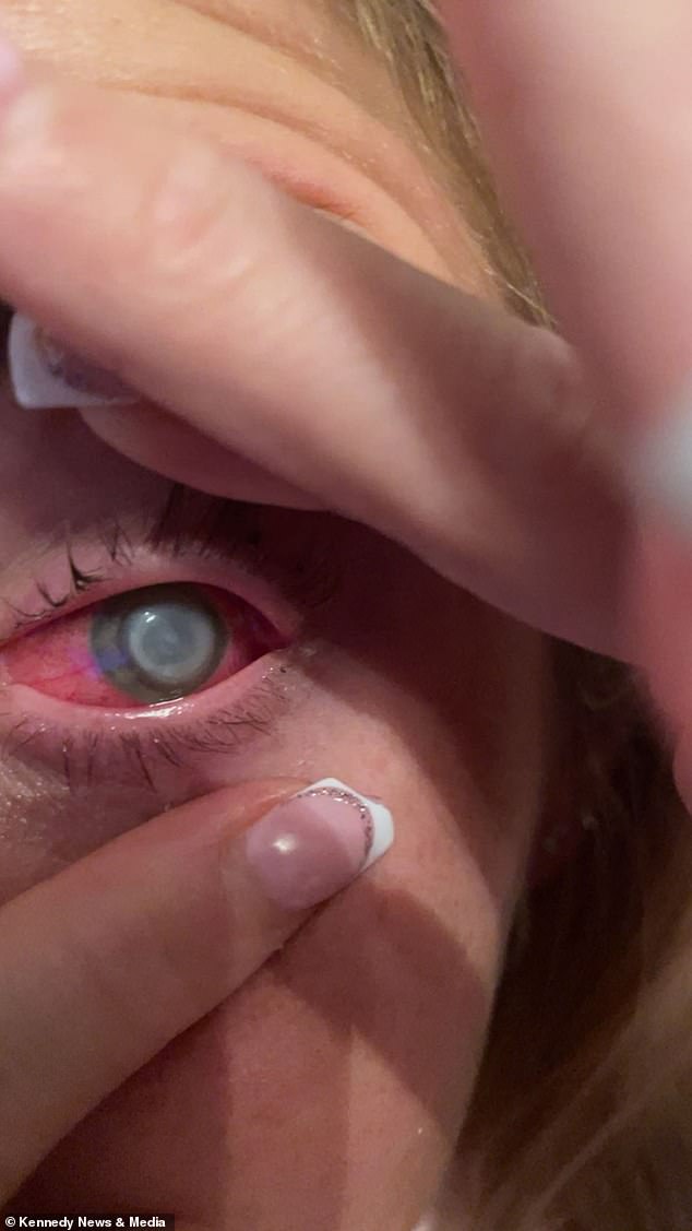Oben ist die schreckliche Augeninfektion abgebildet: ein Hornhautgeschwür, das vermutlich durch Lillies Kontaktlinsen verursacht wurde