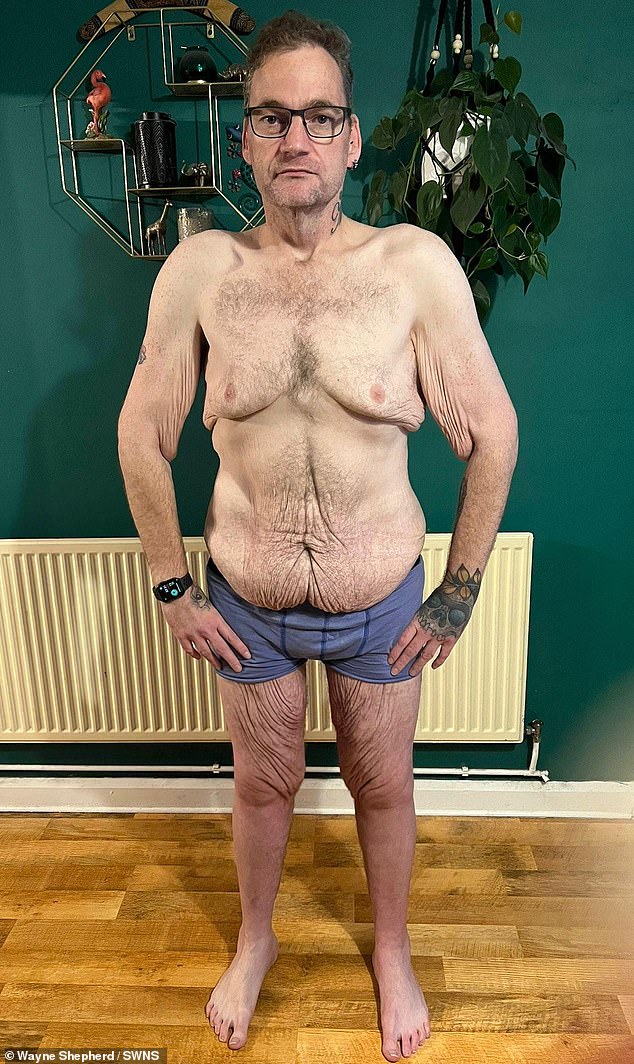 Wayne Shepherd, 41, aus Little Downham, Cambridgeshire, der unglaubliche 24 Kilo verloren hat, hat erzählt, dass er nun 40.000 Pfund für die Entfernung seiner überschüssigen Haut zahlen muss, weil der NHS die Operation nicht finanziert