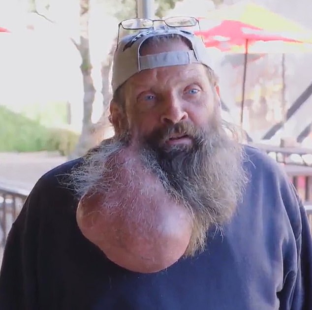 Tim, ein 62-Jähriger aus Scottsdale, Arizona, hatte einen 5,5 Pfund schweren Tumor, der auf der rechten Seite seines Gesichts und Halses wuchs