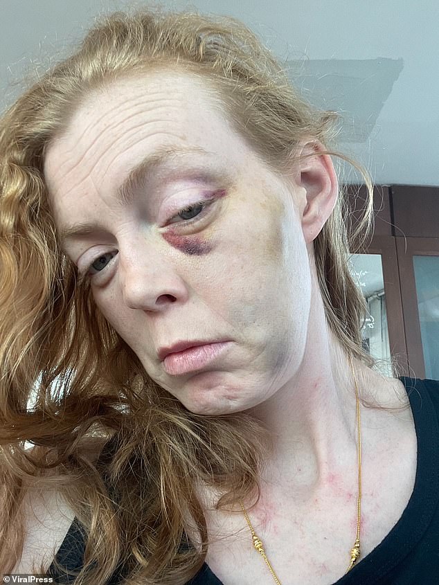 Die verheiratete Mutter eines Kindes, Ayesha Jane Cox, 37, zeigt ihre Verletzungen nach dem Angriff im Jahr 2021