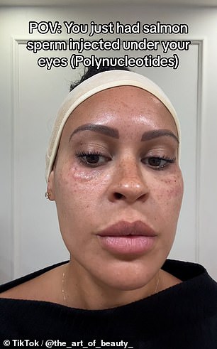Eine in Surrey ansässige Schönheitskrankenschwester @the_art_of_beauty, die knapp über 1.000 Follower hat, hat ebenfalls ein Video von ihrem Gesicht gepostet, kurz nachdem sie sich der Behandlung unter den Augen unterzogen hatte
