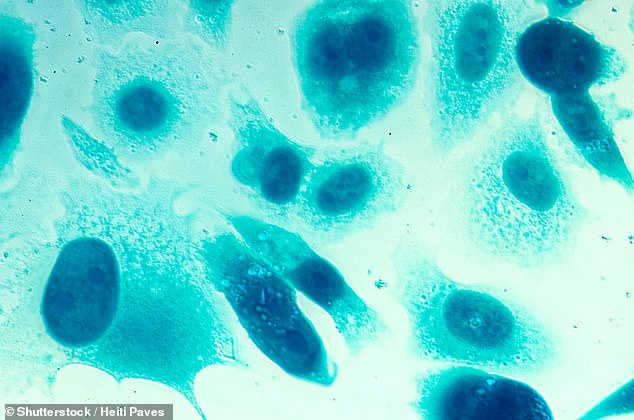 The disease usually has no symptoms until the cancer has grown large and more difficult to treat. At present, men who visit the doctor's with symptoms such as frequent or trouble urinating may be offered a PSA test, although many GP refuse them. Pictured, human prostate cancer cells under a microscope