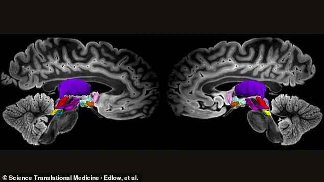 Oben ein MRT-Scan der Hauptknoten des menschlichen Gehirns, von denen die Autoren der neuen Studie behaupten, dass sie der Schlüssel dazu sind, den Menschen wach zu halten.  Die Knoten wurden für ihre neuronale Abbildung farblich gekennzeichnet