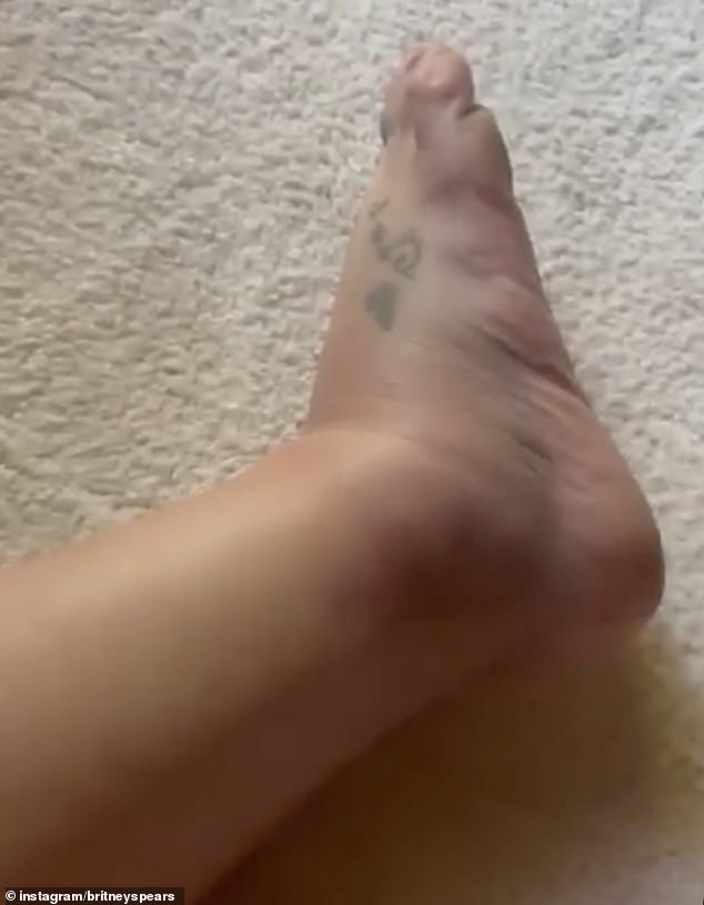 On Friday, Spears posted a video of her swollen foot and ankle and explained, while seemingly slurring, that she 'turned' her ankle on the hotel's staircase.