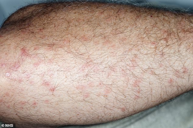 Mückenstiche erscheinen auf der Haut als kleine, erhabene Flecken und können sich manchmal zu mit Flüssigkeit gefüllten Blasen entwickeln (siehe Abbildung).