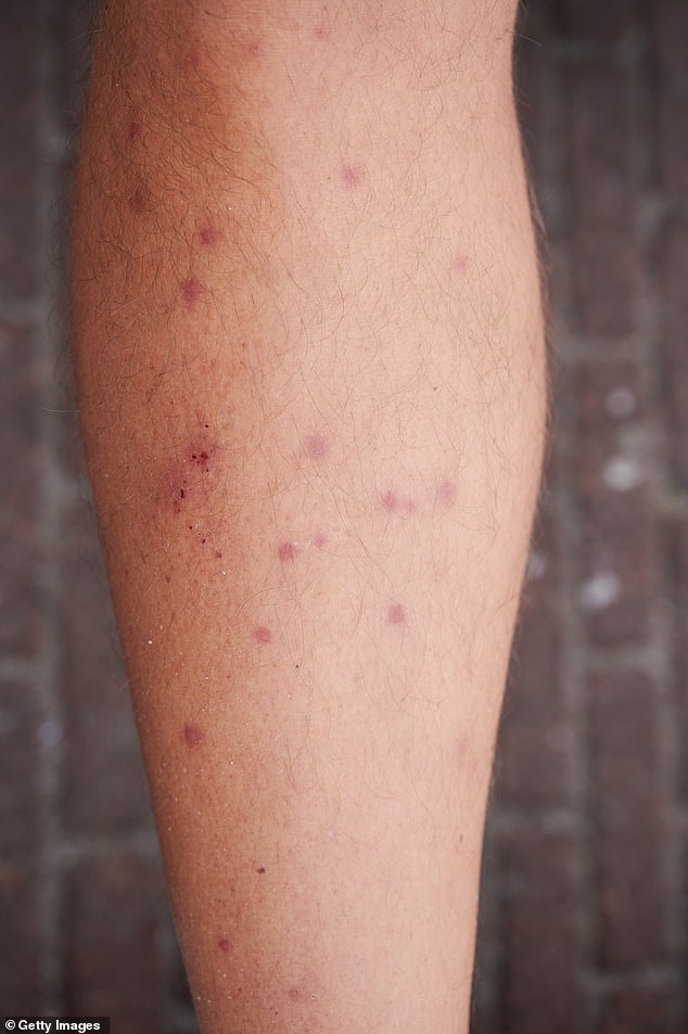 Milbenbisse erscheinen als stark juckende Knoten auf der Haut und können sich manchmal zu Blasen entwickeln – sie sind jedoch nicht lebensbedrohlich (im Bild)