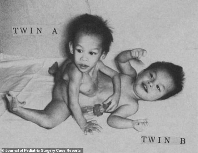 1989 in Pakistan geborene Zwillinge wurden als Kleinkinder in einem fast zehnstündigen Verfahren getrennt