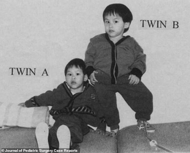 Die Jungen sind zwei von nur einer Handvoll siamesischer Zwillinge von Ischiopagus Tripus, die erfolgreich getrennt werden konnten