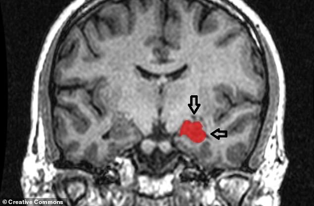 Forschungen zur Gehirnanatomie haben gezeigt, dass das Ausmaß der psychopathischen Tendenzen einer Person offenbar mit der kleineren Größe des Hippocampus (im Bild, MRT-Scan) zusammenhängt – einem Teil des Gehirns, der für die Erstellung detaillierter Darstellungen aus dem Gedächtnis von entscheidender Bedeutung ist