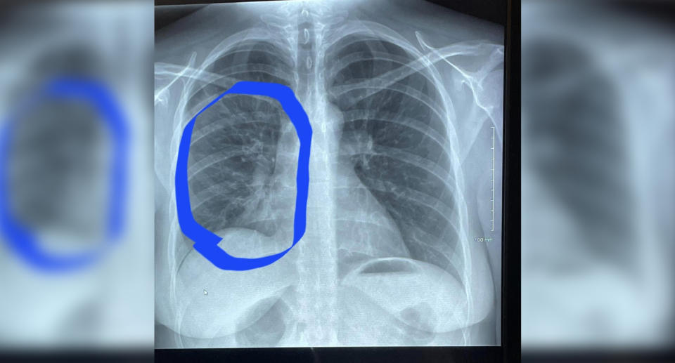 Eine Röntgenaufnahme der Lunge der Mutter.  Quelle: Kennedy News & Pics 