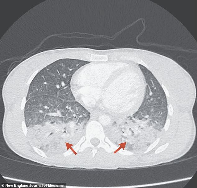 Der namentlich nicht genannte Patient litt unter teilweise kollabierten Lungen und einem „knisternden Geräusch“, das auf eine durch Toxoplasmose verursachte Lungenentzündung zurückzuführen war