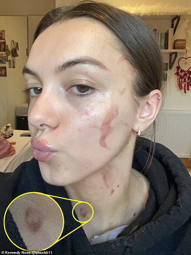 Phoebe Mason, 21, aus Manchester, erlitt Verbrennungen zweiten Grades, nachdem eine Schüssel Heinz Spaghetti Hoops in ihrem Gesicht explodierte