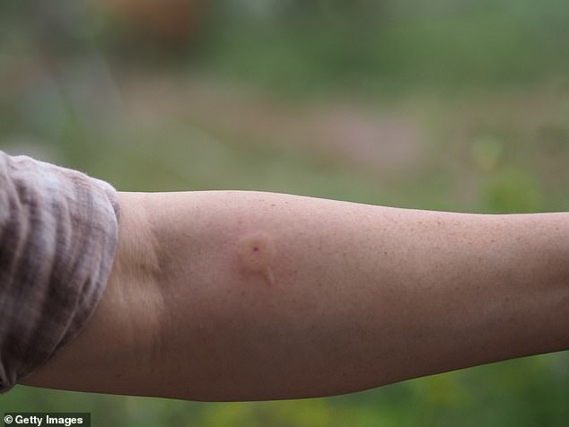 Der Stachel einer Wespe oder Hornisse kann nach einem Stich in der Haut stecken bleiben (siehe Abbildung).