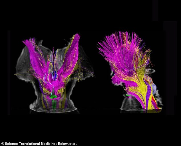 Die neuen hochauflösenden Gehirnscans der Forscher (oben) ermöglichten es ihnen, Gehirnverbindungen auf einer granularen „Submillimeter“-Ebene zu sehen – also bis zu einem winzigen 3/100stel Zoll