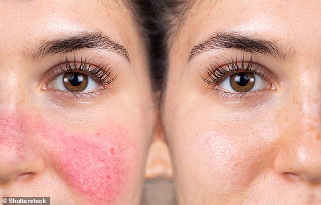 Rosacea, eine Erkrankung, die ein heißes und rotes Gesicht verursacht (links vor der Behandlung und rechts nach der Laseroperation) (Datei)