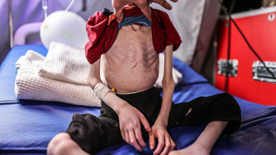 A malnourished child in Gaza lies on a hospital bed.  The ribs are clearly visible