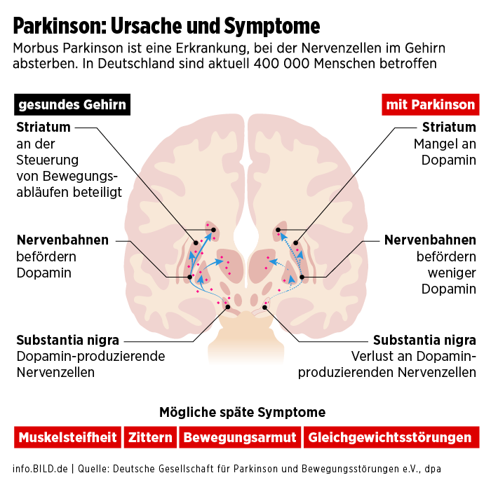 Parkinson: Ursache und Symptome - Infografik